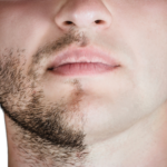 Men's beard laser hair removal